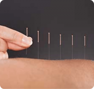 Calgary TCM & Acupuncture | Evolve Chiropractic & Wellness