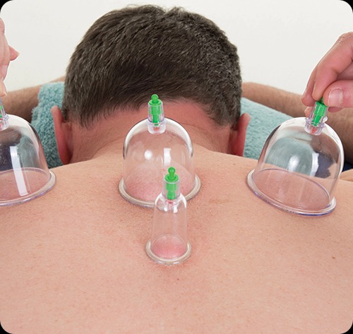 Cupping Therapy